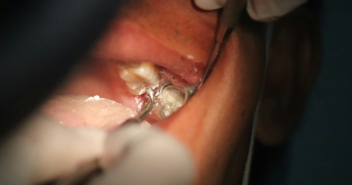 Cáncer de boca: causas, síntomas y tratamientos