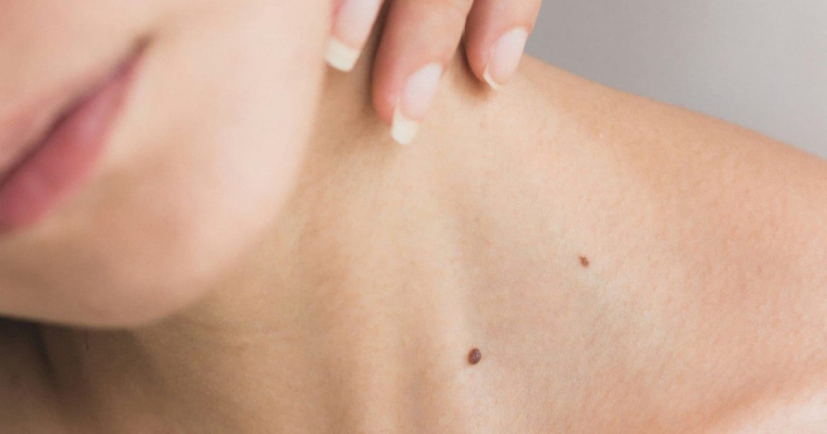 Razones por las que te salen verrugas en el cuello