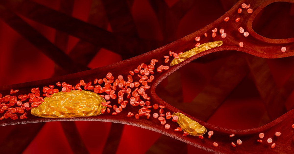 Placas de grasa en tus arterias, conoce qué es la aterosclerosis